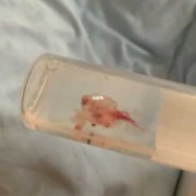 做胎儿绒毛怎么做（胚胎绒毛染色体检查有必要做吗）