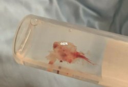 做胎儿绒毛怎么做（胚胎绒毛染色体检查有必要做吗）