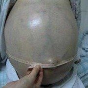小孩腹腔积液是怎么回事,胎儿腹腔积液产生的原因有三