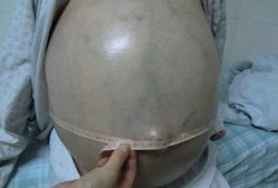 小孩腹腔积液是怎么回事,胎儿腹腔积液产生的原因有三