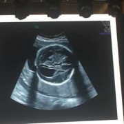 胎儿侧脑室不宽是什么意思（胎儿侧脑室不宽是什么意思呀）