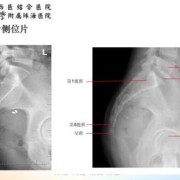 胎儿骶尾椎（胎儿骶尾椎发育异常）