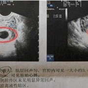 什么是孕囊？孕囊的作用是什么,胎儿发育胎囊图片