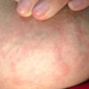 怀孕期间乳头痒（哺乳期奶头痒痒怎么回事）
