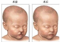 胎儿上颚裂（胎儿上颚裂图片）