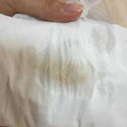 孕期白带恶臭（孕期白带恶臭）