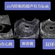 胎囊与胎儿（孕囊回声是什么意思）