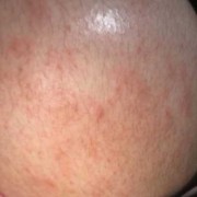 孕妇的肚皮总是感觉很痒的，挺难受的，怎么才能快速止痒,怀孕期间肚子痒怎么办啊