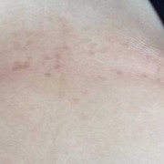 孕期胸上长斑（女性乳房下面突然出现色斑）