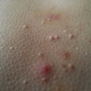 孕期乳房长斑（胸部周围长了许多类似斑点的小点点,怎么回事）