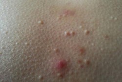 孕期乳房长斑（胸部周围长了许多类似斑点的小点点,怎么回事）