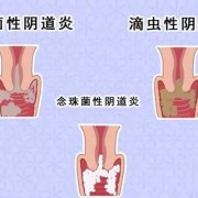怀孕一个月左右有阴道炎会影响胎儿吗,