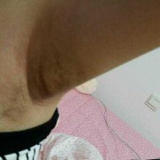 孕期腋下肿大（孕期腋下肿大是怎么回事）