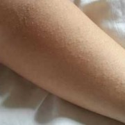 孕妇皮肤长的像痱子粒粒一样还发痒是怎么了,孕期痱子和湿疹图片