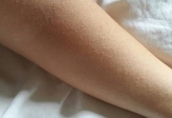 孕妇皮肤长的像痱子粒粒一样还发痒是怎么了,孕期痱子和湿疹图片