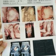 四维彩超显示胎儿的鼻子眼睛都是歪的，会不会是畸形,胎儿眼睛畸形是原因造成的