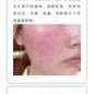 孕期激素皮炎怎么办（激素性皮炎怎么治）