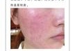孕期激素皮炎怎么办（激素性皮炎怎么治）