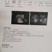 孕期四十天没胎心胎芽（怀孕42天还没有胎心胎芽，怎么办）