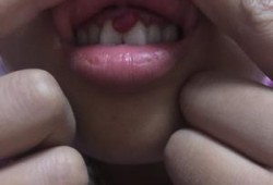 孕期牙龈瘤怎么控制（孕期牙龈瘤怎么控制）