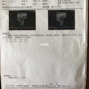 胎儿髋关节（胎儿髋关节脱位四维能发现吗）