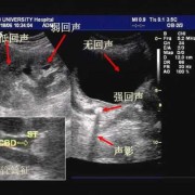 双肾实质及窦区点片状强回声什么意思,胎儿双肾回声增强是什么意思