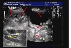 双肾实质及窦区点片状强回声什么意思,胎儿双肾回声增强是什么意思