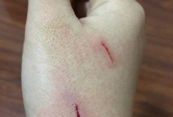 孕期被狗咬了（孕期狗咬了打针影响宝宝吗）