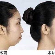 胎儿下巴短（下巴短怎么让下巴变长）