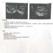 怀孕了但是有积液，怎么办,胎儿有积液对胎儿有什么影响呢?