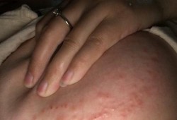 孕期胸部痒怎么回事（孕期胸部痒怎么回事啊）