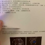 胎儿心超费用（胎儿心超费用多少）