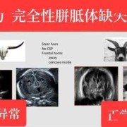 胎儿复合体（胎儿复合体是什么意思）