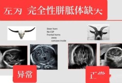 胎儿复合体（胎儿复合体是什么意思）