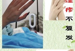 孕期的湿疹怎么办啊（孕妇湿疹怎样快速止痒有什么好的办法的吗，快要用湿疹药膏的吗）