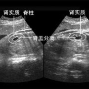 胎儿双肾盂未见分离（双肾盂无分离是什么意思）