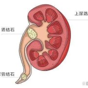 肾盂积水是怎么回事,胎儿肾盂积水是怎么回事