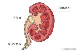 肾盂积水是怎么回事,胎儿肾盂积水是怎么回事