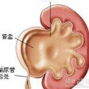 胎儿肾积水是男孩吗（胎儿肾积水是男孩吗?）