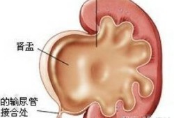 胎儿肾积水是男孩吗（胎儿肾积水是男孩吗?）