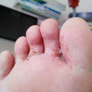 孕期足藓（孕期足藓怎么治疗）
