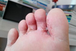 孕期足藓（孕期足藓怎么治疗）