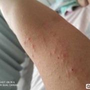 孕期皮疹（孕期皮疹图片和症状）