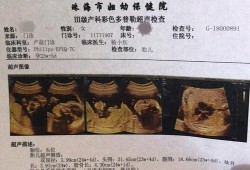 胎儿三级检查（胎儿三级筛查是大排畸吗）