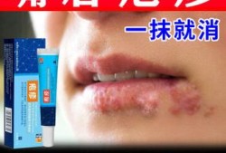 孕期嘴巴上火起泡怎么办（上火嘴唇起泡吃什么药好）