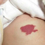 胎儿有胎记是什么原因（宝宝的胎记是如何形成的）