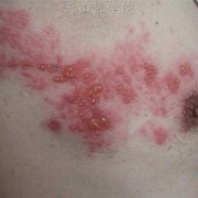 孕妇得了疱疹怎么办,孕期疱疹对胎儿有影响吗