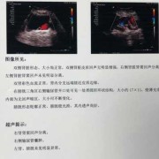 输尿管囊肿怎么办,胎儿输尿管囊肿2周消失了