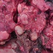 胎儿肝内钙化灶（肝内钙化灶是什么）