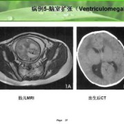 胎儿磁共振（新生儿照核磁共振是为什么）